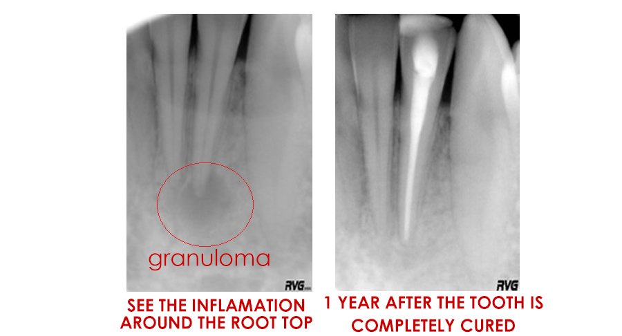 endodoncija-slika2-ENGLESKI.jpg