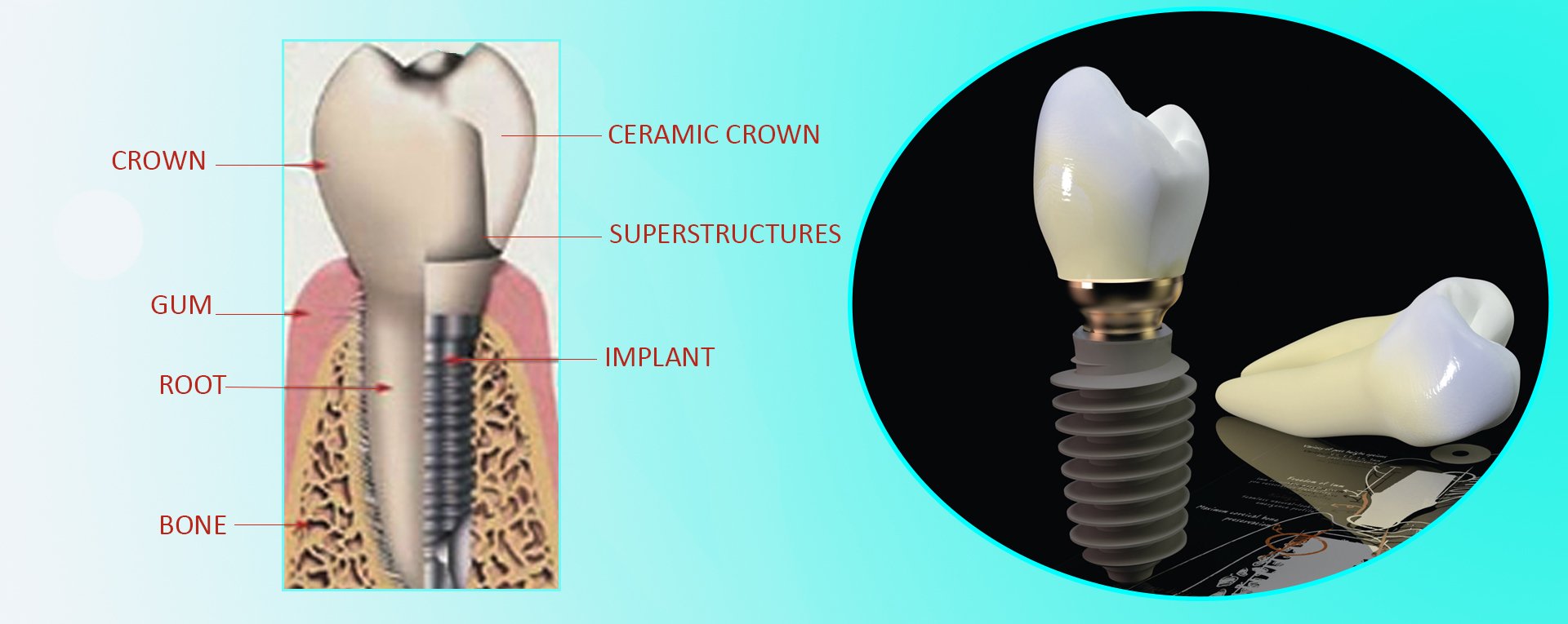 implantat-objašnjenje-sa-crticama-ENG-www.jpg