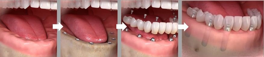 IMP-donja čeljust-nedostaju svi zubi-6impl.JPG