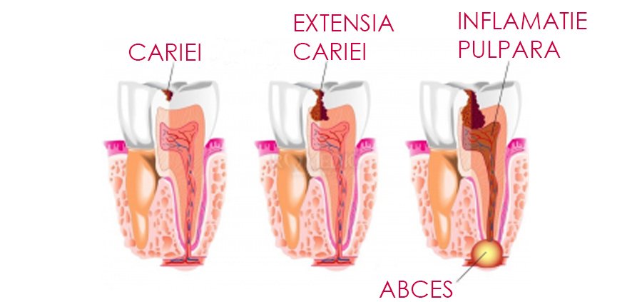 endodoncija slika 1 ENG www.jpg