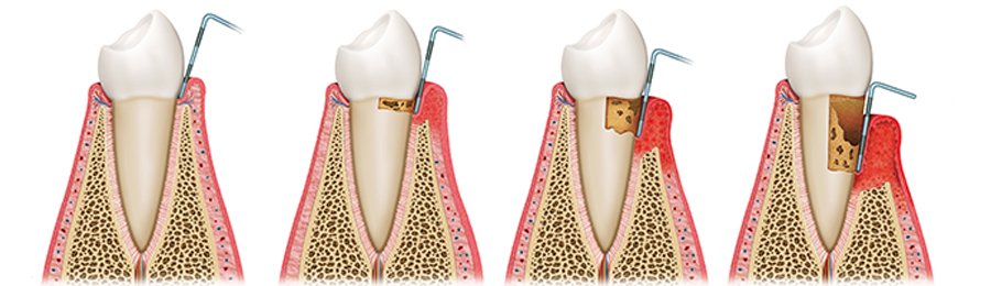 parodontitis-www.jpg
