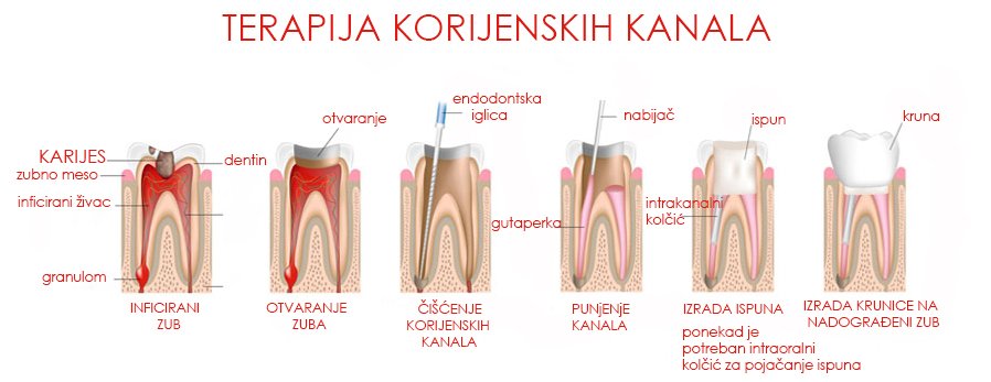 endodoncija slika HR 3 www..jpg